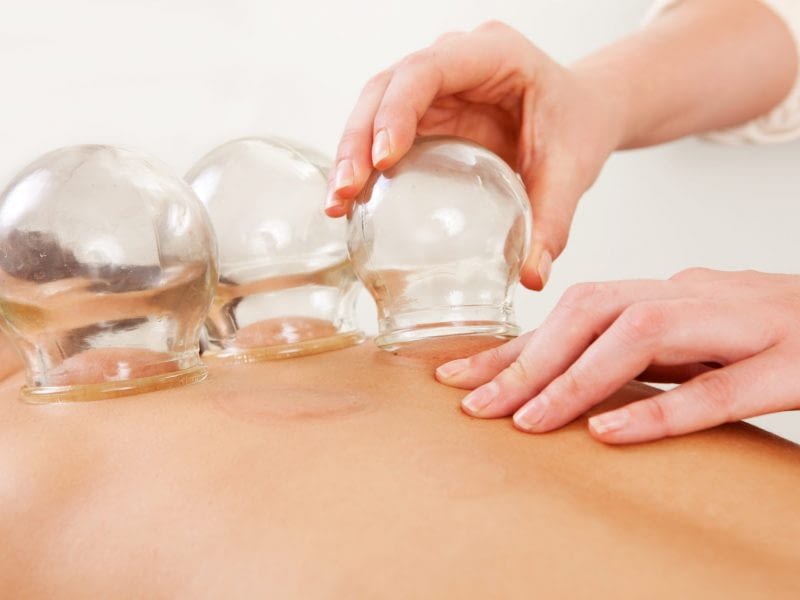Θεραπεία Ψυχρών Βεντουζών - Cupping Therapy